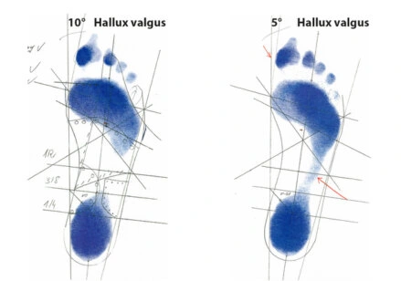 Korrekturbeispiel 2 Hallux valgus